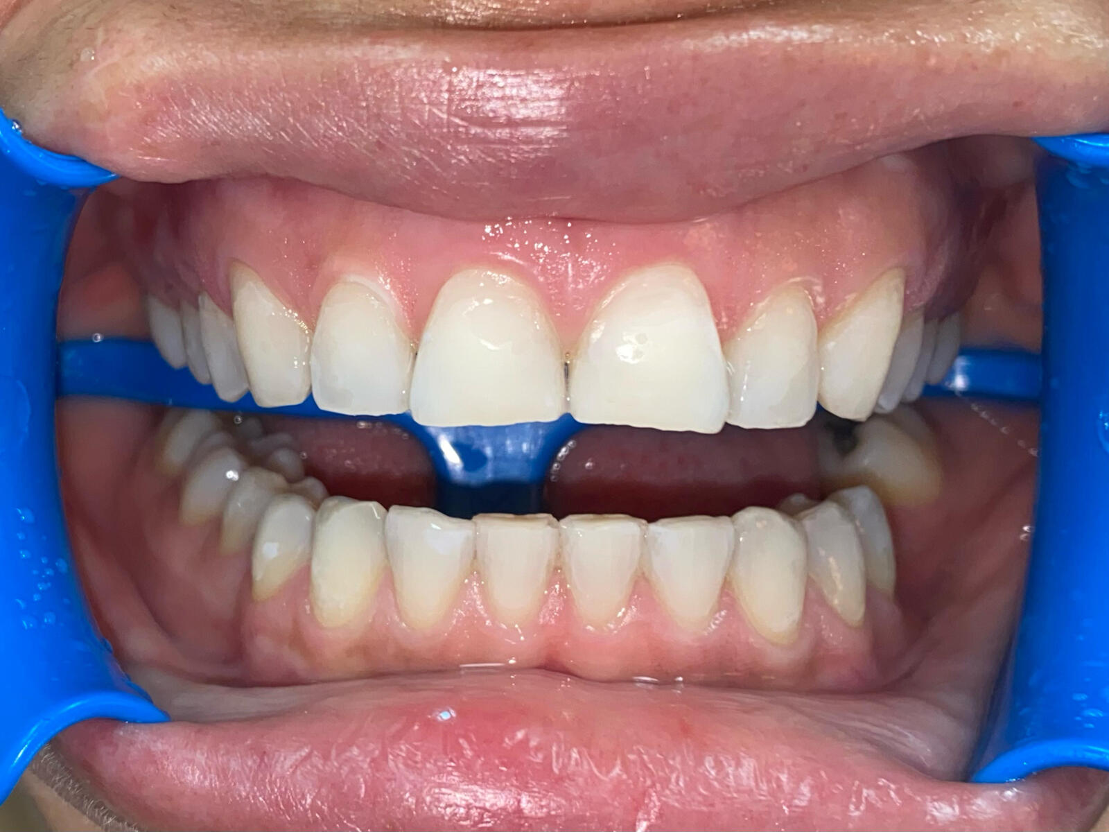 Branqueamento Dentário Dental Mafamude
